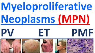 Myeloproliferative Neoplasms explained [upl. by Aidil375]