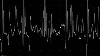 EMG teaching video 11 Complex repetitive discharge CRDs [upl. by Correna402]