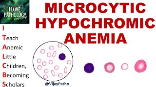 MICROCYTIC HYPOCHROMIC ANEMIA Causes Mechanism amp Approach [upl. by Arutnev724]