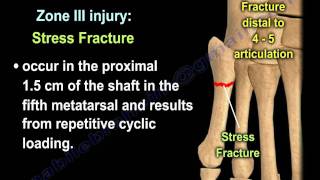 Proximal Fifth Metatarsal Fractures  Everything You Need To Know  Dr Nabil Ebraheim [upl. by Saiff831]