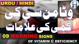 Vitamin C Benefits  Vitamin C Deficiency Symptoms amp Vitamin C Rich Foods  Health Tips Urdu Hindi [upl. by Aivatnohs359]