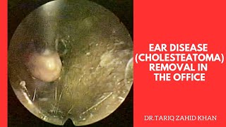 EAR diseaseCholesteatoma removal in the office [upl. by Nolek]