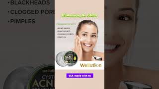 Wellution Cystic Acne Treatment face Cream howtolightendarkspots antiaging [upl. by Leroj]