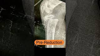 Close reduction of proximal epiphyseal slip of tibia in kids  SALTERHARRIS type 1 [upl. by Upshaw]