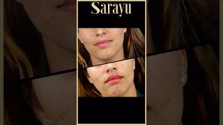 Achieve Perfectly Balanced Lips with Lip Fillers  Sarayu Clinics fillers [upl. by Rondon]