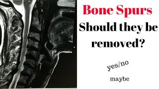 Bone spurs cause pain [upl. by Attenaj]