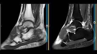 Ankle pain secondary to sinus tarsi and and spring ligament injuries [upl. by Eecyaj738]