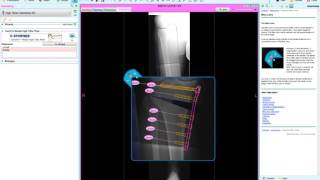 High Tibial Osteotomy HTO 2  Deformity Correction Planning  Materialise OrthoView [upl. by Adelaja]