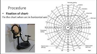 perimetry viva questions [upl. by Arrimat]