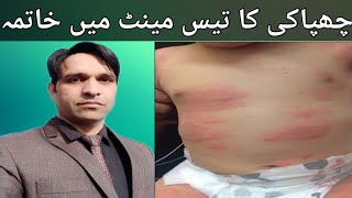 Urticaria homeopathic treatment  Urdu Hindi  چھپاکی کا ہومیو پیتھک علاجbesttreatment urticaria [upl. by Saville]