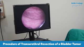 Transurethral Resection of Bladder Tumor  Procedure  Delhi Urology Hospital [upl. by Ainahs95]