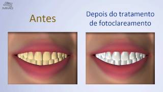 Clareamento a LED MM Optics [upl. by Peednus393]