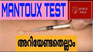 Mantoux Test  Tuberculin Skin Test TST Malayalam [upl. by Nnyleve]