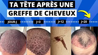 4 réactions flippantes après ta greffe de cheveux et qui sont normales vol2 [upl. by Reifnnej]