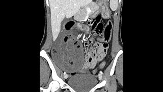 Small bowel ischemia associated with a parastomal hernia postileostomy in a Crohns disease patient [upl. by Airod]