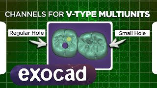 Exocad tutorial  Choosing between regular and small screw channels for Vtype multi units [upl. by Elvia990]