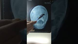 Mastoid process Air sinuses MBBS Life 🩺 MBBS practical time mbbs neet motivation trending [upl. by Elledoj]