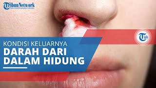 Mimisan Pendarahan dari Bagian Dalam Hidung yang Sering Disebut Juga dengan Epistaksis [upl. by Kape]