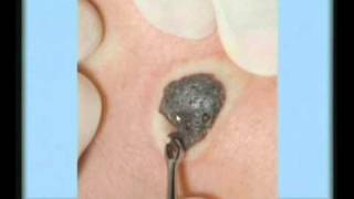 Seborrheic Keratosis Treatment [upl. by Radbun]