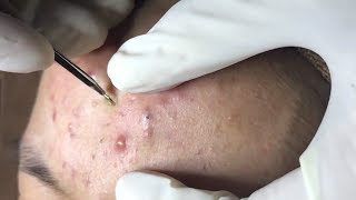 How To Remove Blackheads And Whiteheads On Face Easy 59 ✦ Dr Laelia ✦ [upl. by Arretal663]