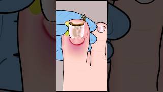 ASMR Ingrown Toenail Removal Treatment asmr animation satisfying viral shorts youtubeshorts [upl. by Philippa]