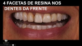 4 Dentes da Frente com Facetas de Resina [upl. by Dearborn]