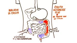 Maladie Inflammatoire de Lintestin MII [upl. by Kimbra]