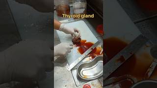 Cystic thyroid gland gross pathology [upl. by Michaud459]