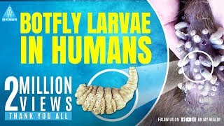 botfly larvae in humans [upl. by Siladnerb]