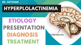 Hyperprolactinemia  increase prolactin levels [upl. by Nyleahs]