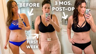 Tummy Tuck 3 Month Post op Update Before and After In Pictures  Mommy Makeover [upl. by Kho]