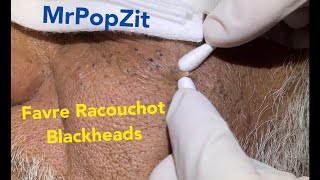 FavreRacouchot syndrome Multiple blackheads and whiteheads clustered together Face Extractions [upl. by Lotsirk725]