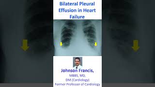 Bilateral Pleural Effusion in Heart Failure [upl. by Ash424]