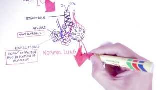 Emphysema  Introduction Types Symptoms Diagnosis [upl. by Xavler326]