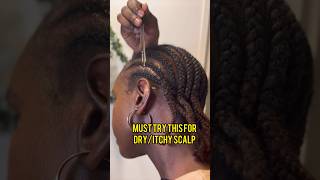 Must Try this for Itchy scalp [upl. by Eceirtal]