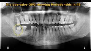 Extraction of wisdom tooth with periosteal elevator [upl. by Liebermann]