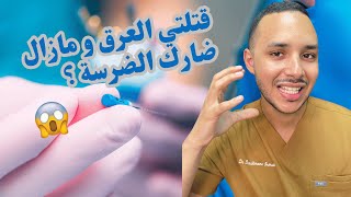 قتلتي العرق و مازال ضارك الضرسة ؟واش عادي أو لا؟ [upl. by Hadden]