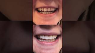 Composite bonding before vs after A few hours difference 😍 compositebonding newsmile [upl. by Woll75]