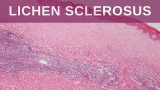 Lichen Sclerosus  Pathology mini tutorial [upl. by Taran]