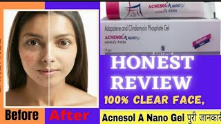 Acnesol A Nano Gel Honest Review Adapalene and Clindamycin Phosphate Gel 7 दिन में पिंपल्स गायब [upl. by Garaway]