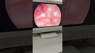 Endoscopic view of Anchored Vocal cord Polyp Right side [upl. by Arikat363]