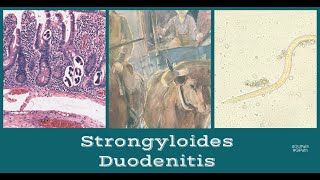 Strongyloides Duodenitis [upl. by Annagroeg]