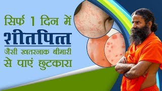 सिर्फ 1 दिन में Urticaria शीतपित्‍त जैसी खतरनाक बीमारी से पाए छुटकारा  Swami Ramdev [upl. by Alyag]