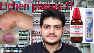 Lichen planus Homeopathic medicine for lichen planus explain [upl. by Nosreg]