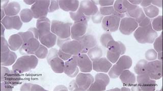 Plasmodium falciparum ring form in thin blood smear [upl. by Canfield]