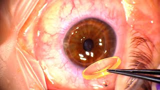 Corneal Transplant Penetrating Keratoplasty for Advanced Keratoconus and Corneal Infiltrates [upl. by Silver]