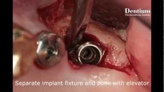 Fixture removal of malpositioned implant 27 [upl. by Arsi]