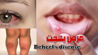 مرض بهجت Behçets disease [upl. by Allister]