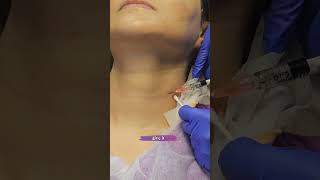 skinbooster  dermalfillers for Neck lines profhilo viscoderm antiagingtreatment skincaretips [upl. by Proudfoot]