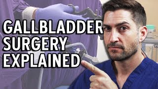 Gallbladder Surgery Explained  Complications and Recovery [upl. by Ssenav]